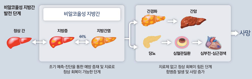 지방간 증상, 원인, 치료, 예방 (비알콜성지방간, 알콜성지방간)