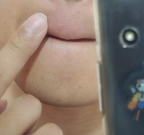 아토피연고-노하우