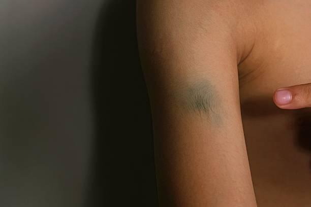 폴댄스 멍이 생기는 이유와 관리 방법