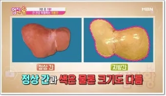 비알콜성 지방간 없애는 방법 운동 식단 중심 회복법 정리_20