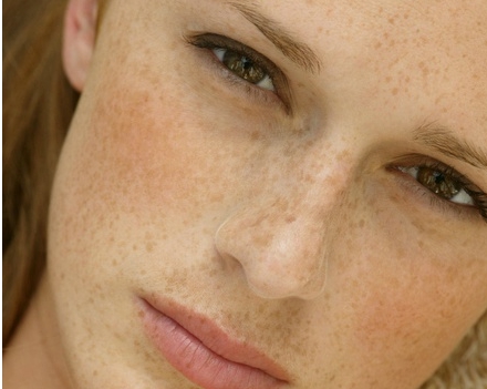 검버섯 없애는 방법