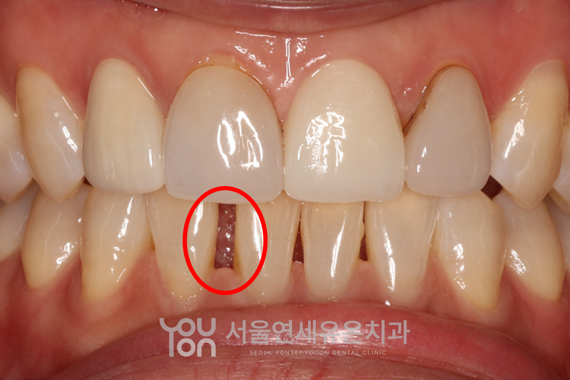 아래 앞니 사이 공간이 형성된 치료 전 상태 - 빨간 표시 부위에 공간이 뚜렷하게 보이는 모습