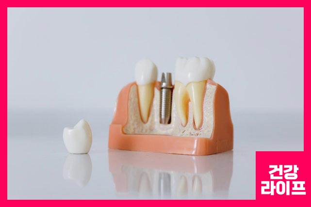 임플란트 뼈이식 필요한 경우