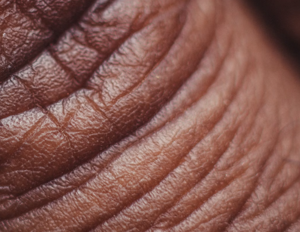 히알루론산 : 피부