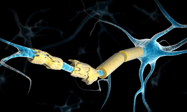 다발성 경화증 원인