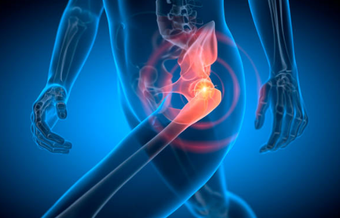 고관절 통증 증상, 통증 원인, 수술 총정리 (2024ver)