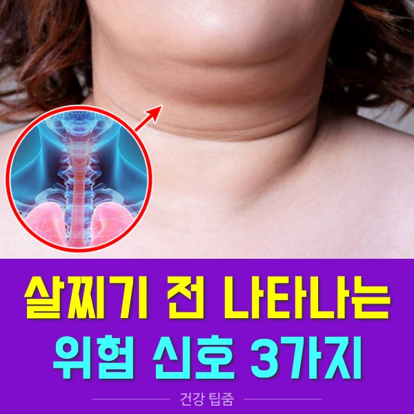 살찐 혀 깨물었을때 기도가 막히는 수면무호흡증, 내장지방 빼는법, 다이어트 건강 팁줌 매일꿀정보