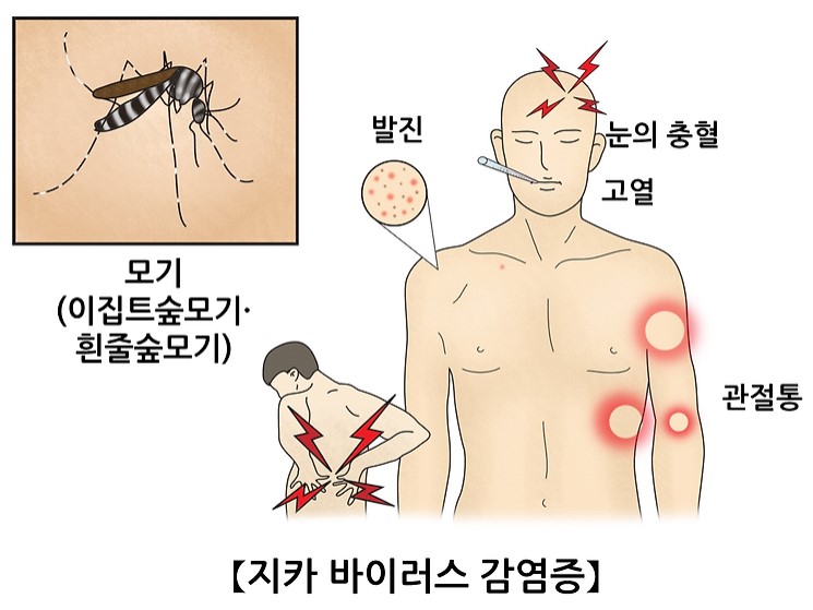 지카바이러스감염증