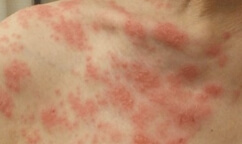 대상포진 피부 증상