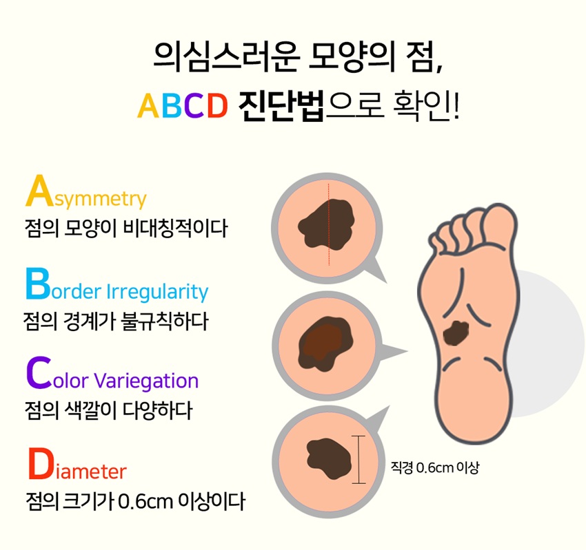 흑색증 ABCD 진단법