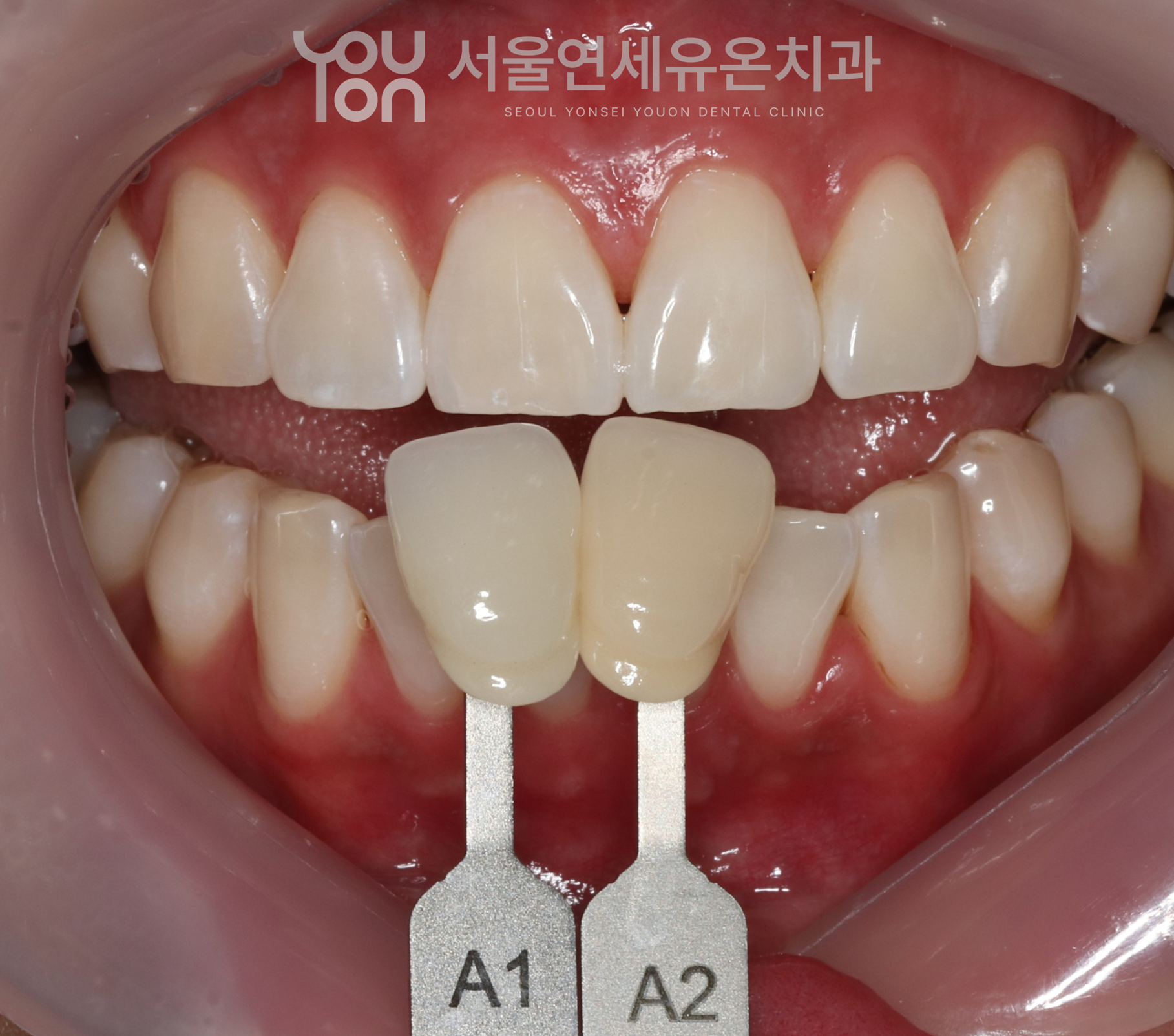 미백 후 색상 측정 - 미백 전에 비하여 두 단계정도 밝아짐