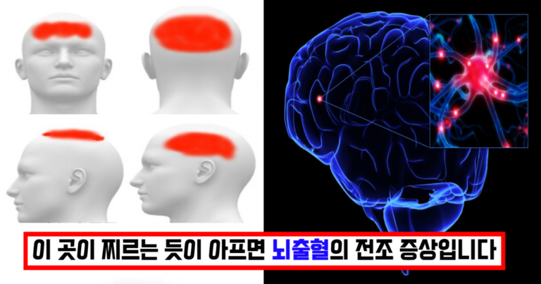 뇌출혈증상