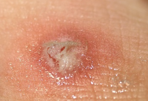 티눈 없애는 방법