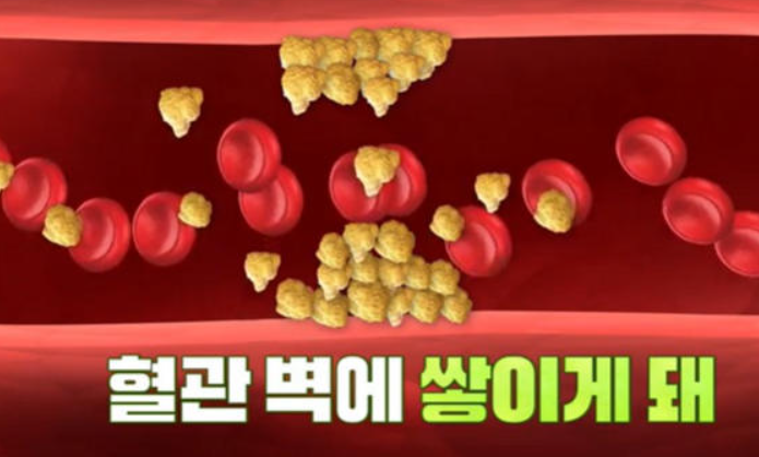 플라크 생기는 혈관