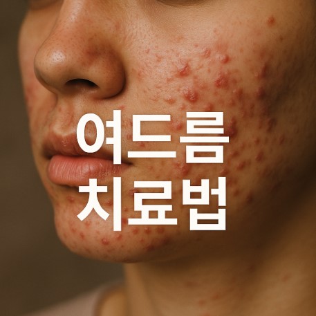여드름, 가만히 놔두면 정말 사라질까? (자연치유, 여드름 자국, 흉터까지 총정리)