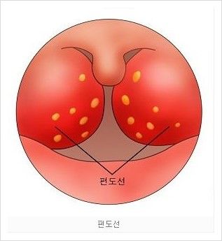편도선염 증상