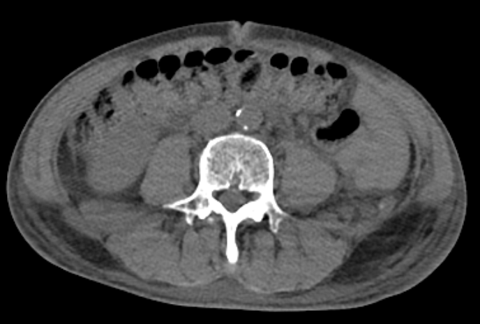 Normal Abdomen CT