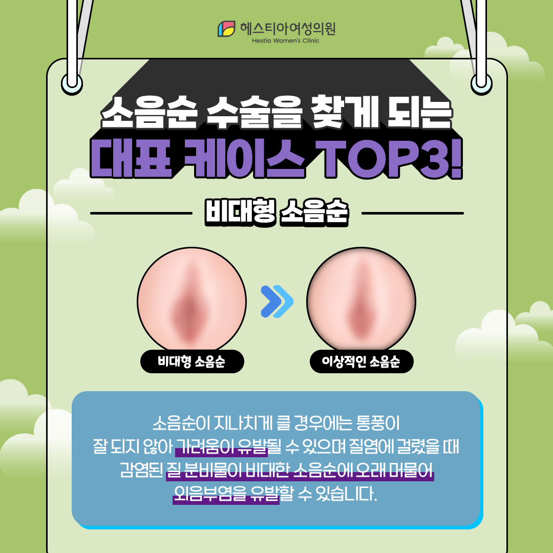 비대형 소음순