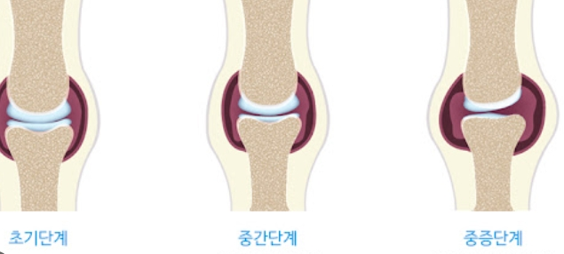 60대 관절염 예방하는 확실한 방법 - 무릎 건강 지키는 생활 습관
