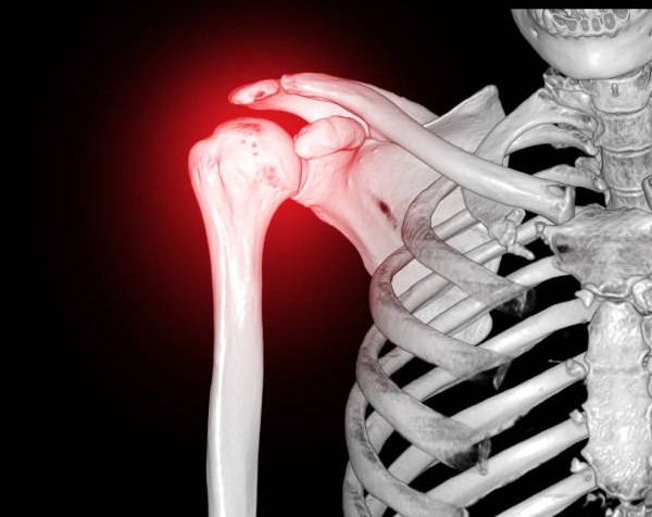 오십견 증상 치료3