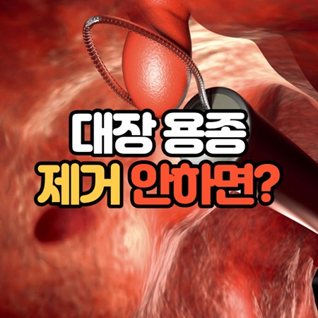 대장 용종 암 확률