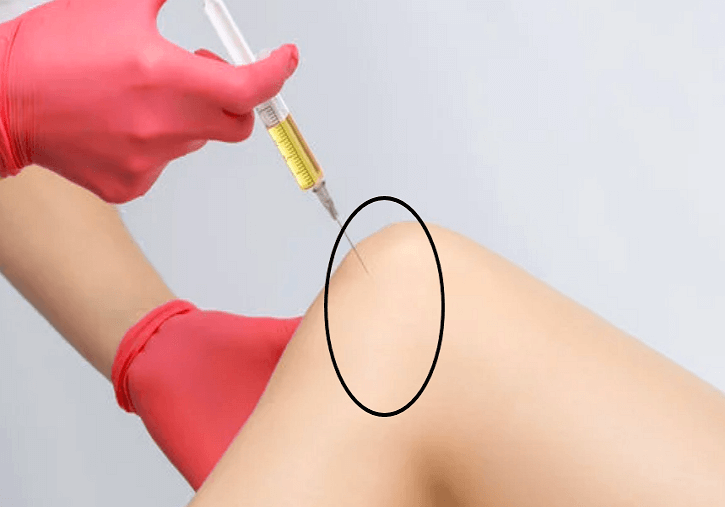 무릎연골주사 썸네일