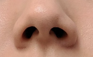 코조각주사 후기