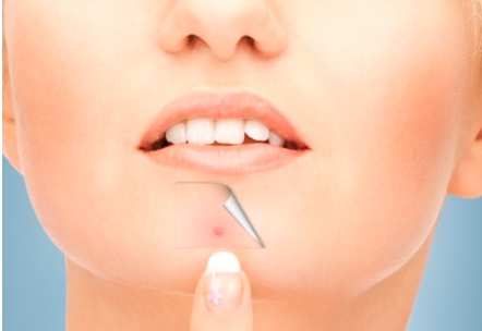 부위별 여드름 원인