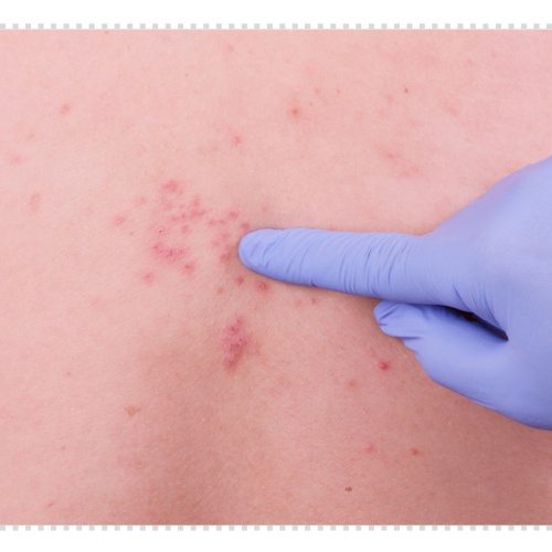 귀 대상포진 증상 후유증