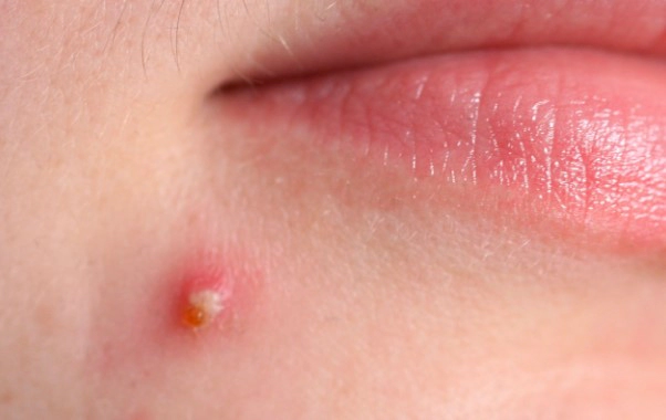 화농성 여드름 연고 3가지 추천 및 화농성 여드름 관리법 총정리 