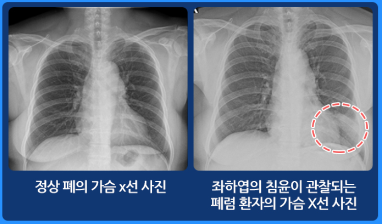 정상인과 폐렴환자의 가슴 X선 비교