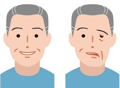 안면마비 이미지