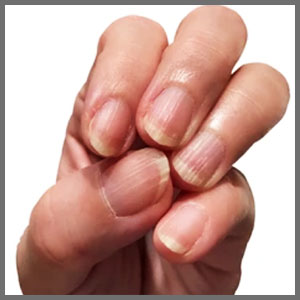 손톱-세로줄-노화