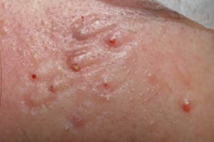 쏘팔메토의 효능