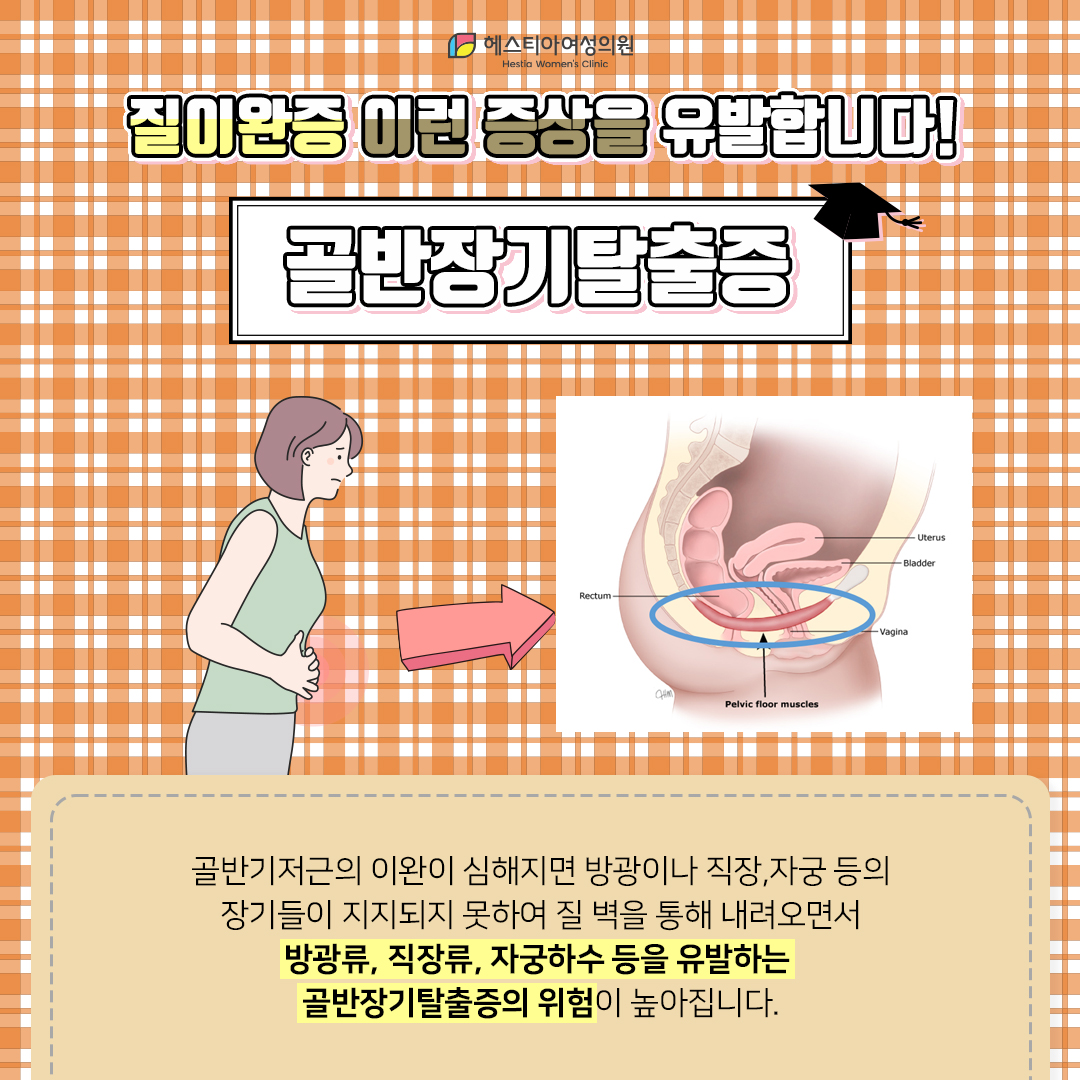 질이완증 골반장기탈출증