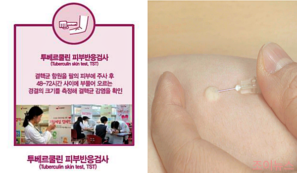 투베르쿨린 피부 반응 검사란?