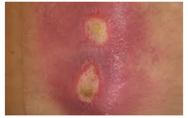 욕창은 얼마나 심각한 증상인가?