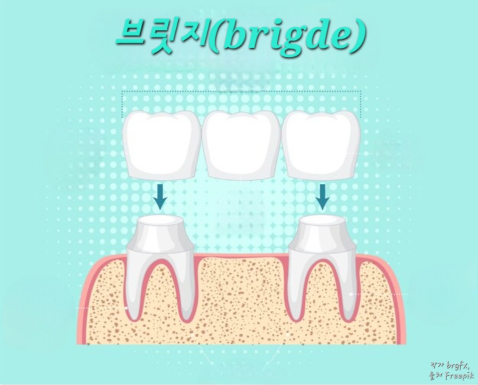 브릿지치료
