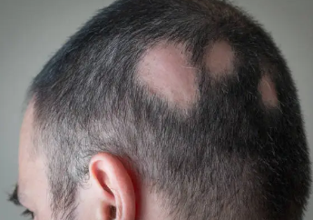 원형탈모