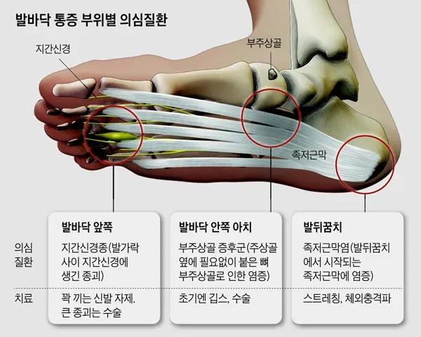 발바닥통증의 원인들과 해결책_6