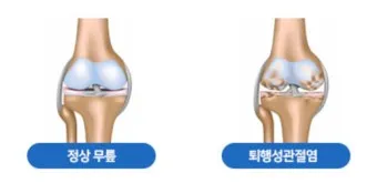 관절염에 좋은 음식 TOP 10_27
