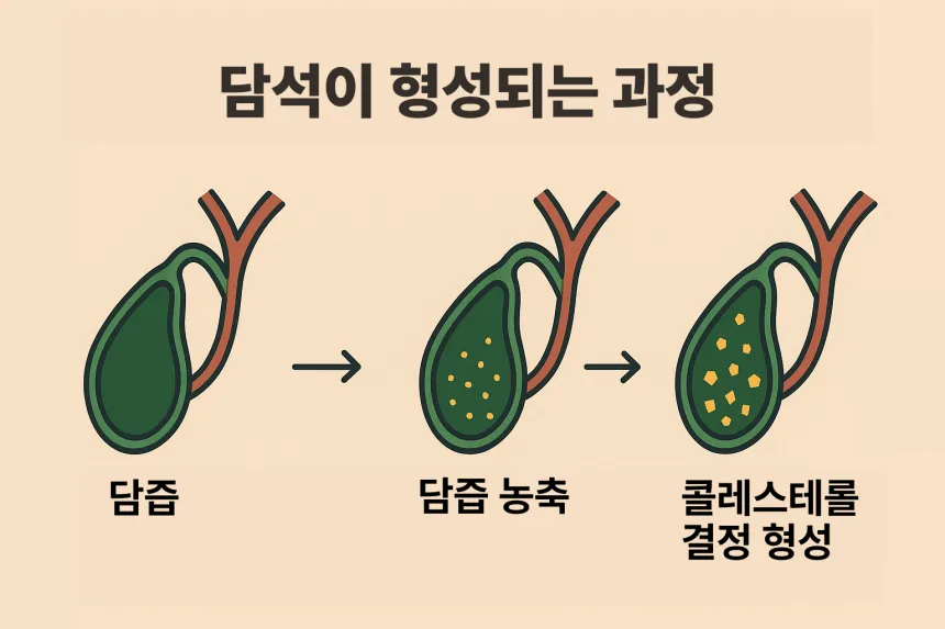 담석증 증상