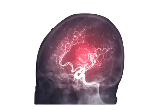 뇌경색 초기증상&amp;#44; 원인 및 치료 방법