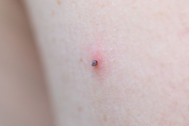 쯔쯔가무시 예방법