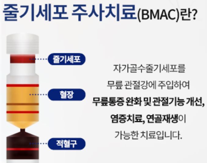 무릎줄기세포주사 가격 및 무릎줄기세포주사 실비 실손 보상 / 전국 병원추천