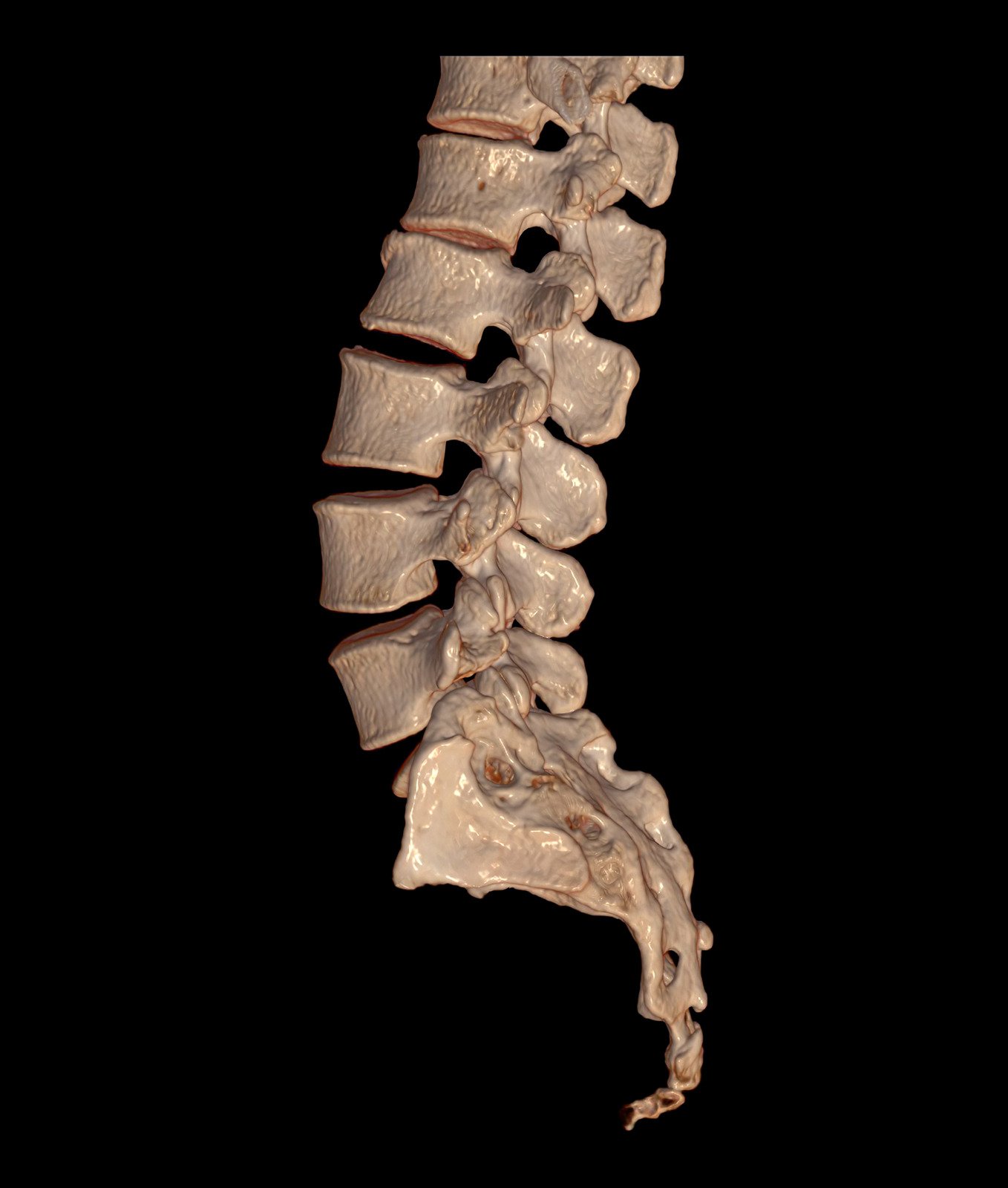 척추 골절(Compression Fracture, 압박골절): 원인, 증상, 치료 및 예방