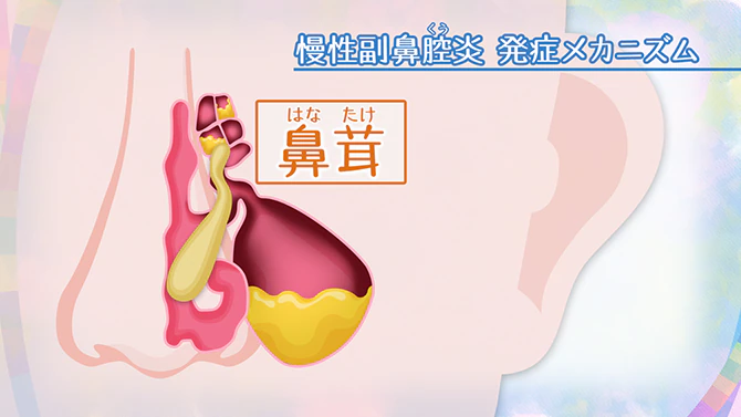 부비동염