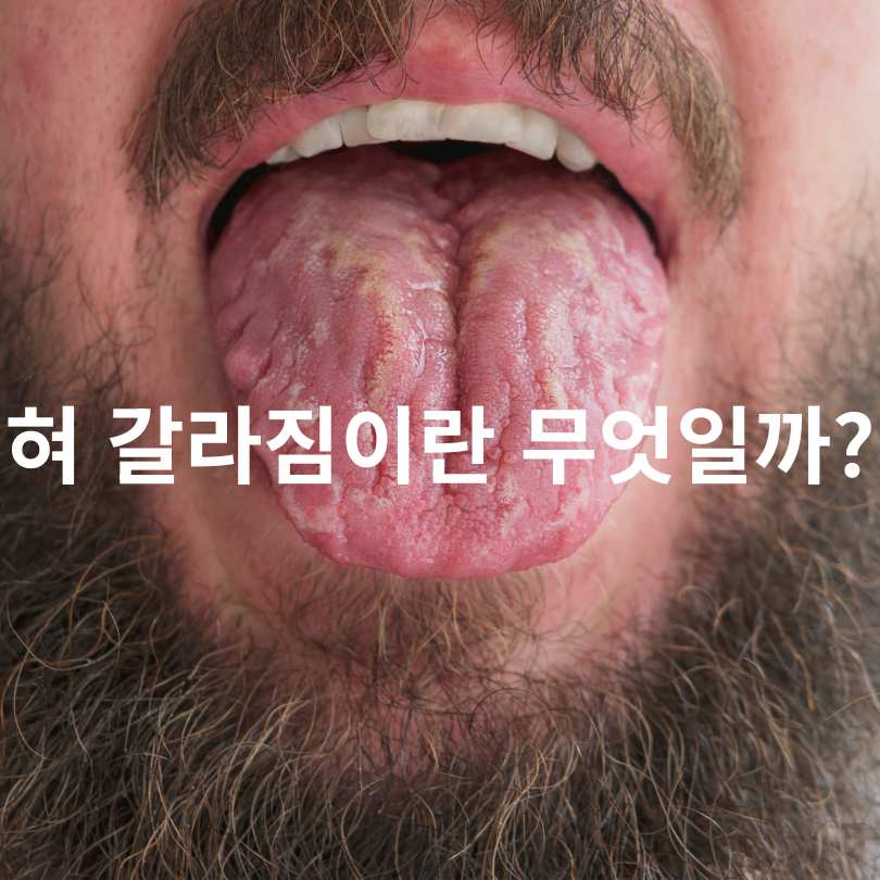 혀 갈라짐의 원인과 대처법