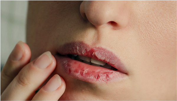 입술건조-각질출혈