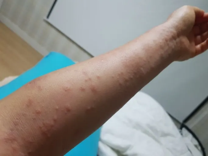 팔전신에-퍼진-알레르기-염증